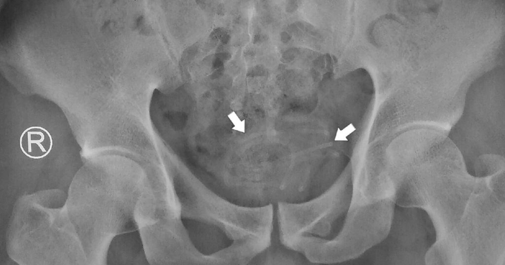 Polyembolokoilamani - results of trauma to the urethra