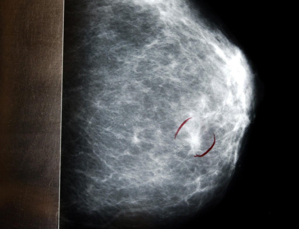 Large increase in breast cancer
