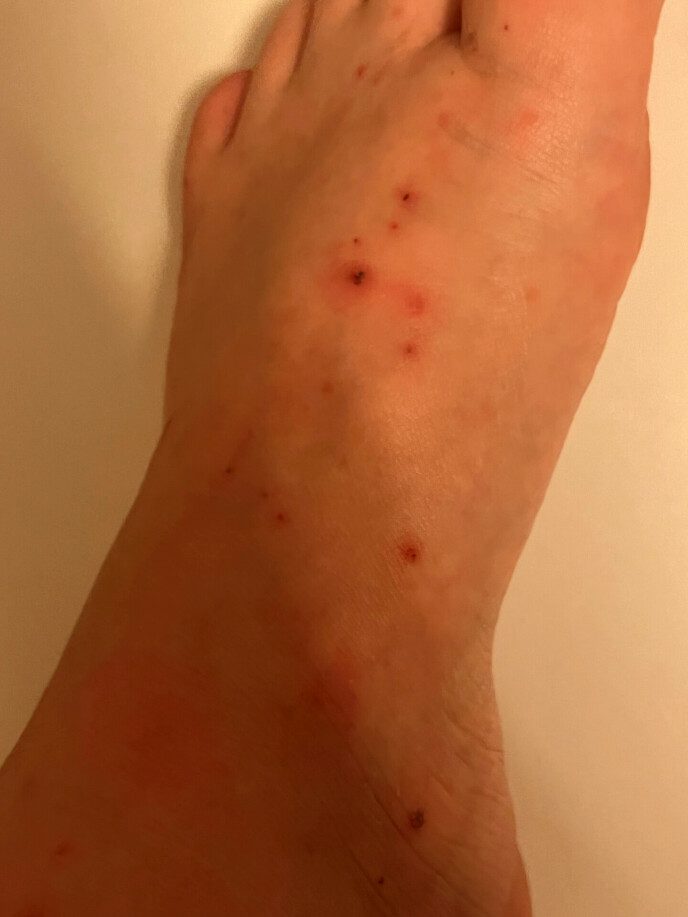 Points: This is what Victoria's feet looked like before she was diagnosed.  Photo: Private