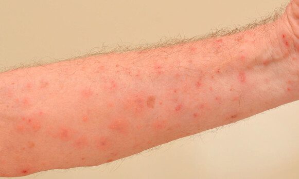 Blisters and Bumps: The symptoms of scabies are itching, often worse at night and with sweating, often first on the hands and then on large areas of the body.  Photo: Shutterstock