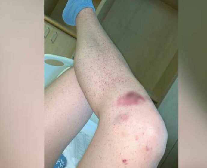 Full of dots: This is what Juliana's legs looked like when she was admitted to the hospital.  Today, I learned it was a danger signal.  Photo: Jam Press